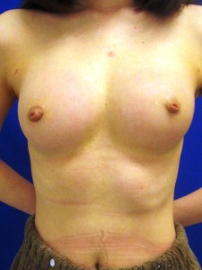 ②術後3ヶ月　右前斜位